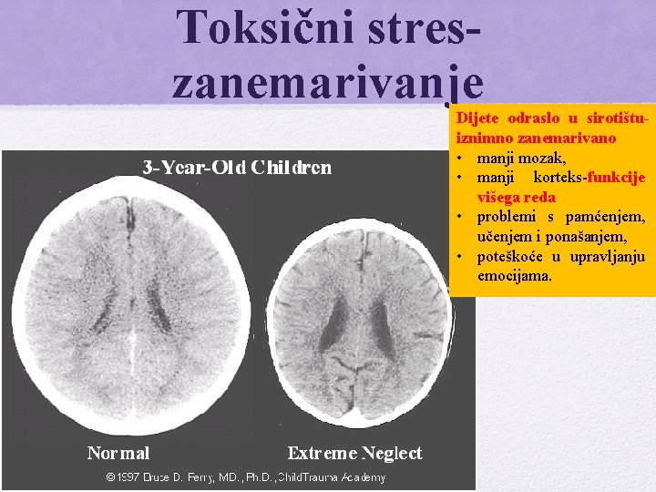 Toksični streszanemarivanje Dijete odraslo u sirotištuiznimno zanemarivano • manji mozak, • manji korteks-funkcije višega