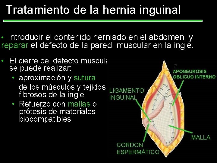 Tratamiento de la hernia inguinal • Introducir el contenido herniado en el abdomen, y