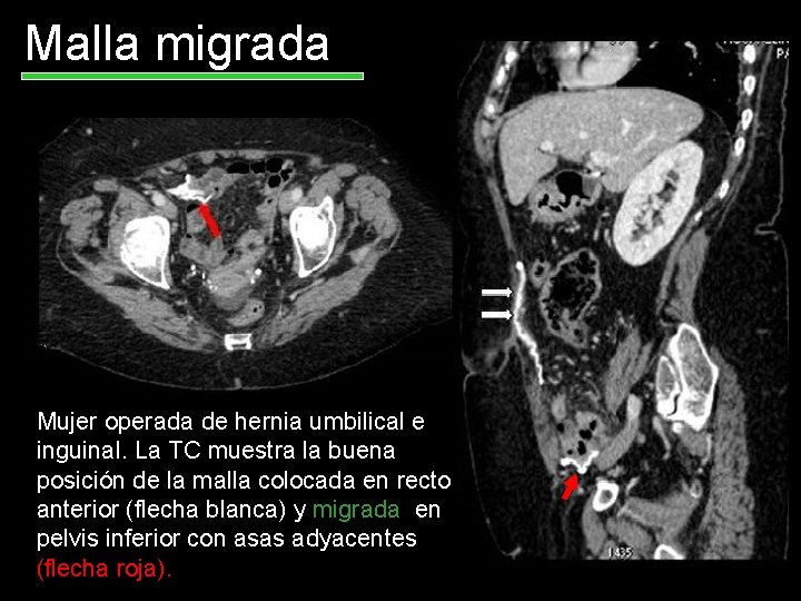 Malla migrada Mujer operada de hernia umbilical e inguinal. La TC muestra la buena