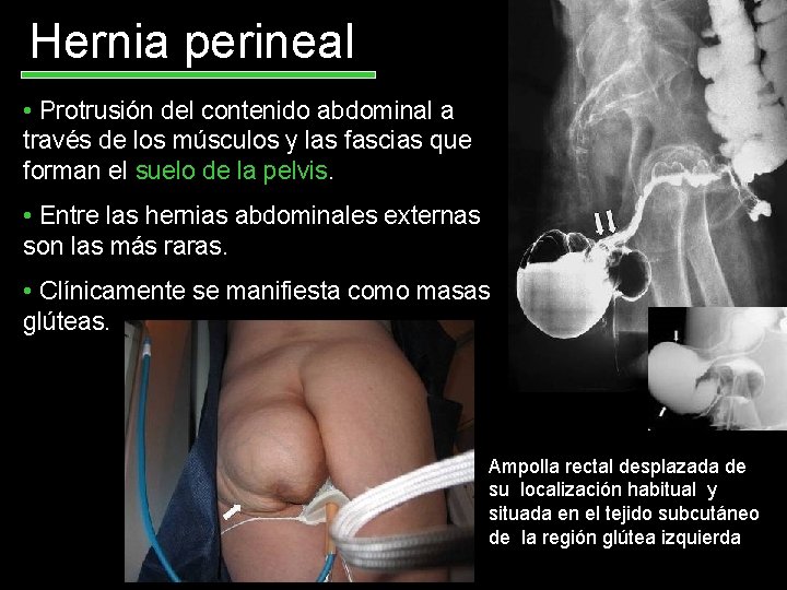 Hernia perineal • Protrusión del contenido abdominal a través de los músculos y las