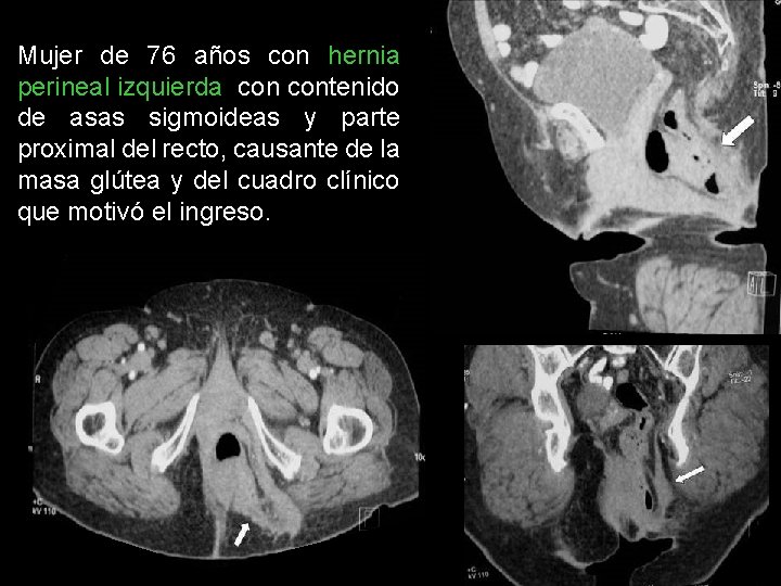 Mujer de 76 años con hernia perineal izquierda contenido de asas sigmoideas y parte