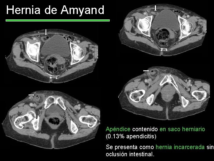 Hernia de Amyand Apéndice contenido en saco herniario (0. 13% apendicitis) Se presenta como