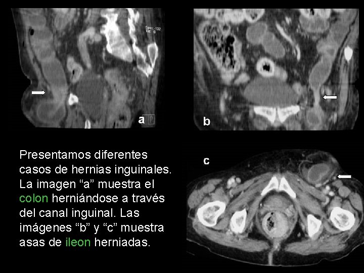 Presentamos diferentes casos de hernias inguinales. La imagen “a” muestra el colon herniándose a