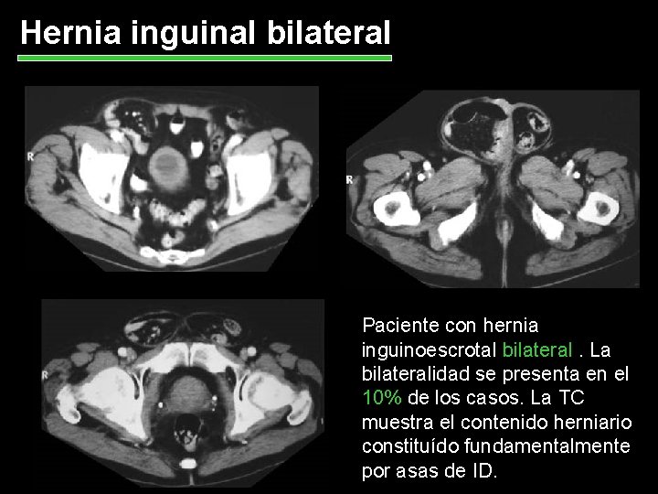 Hernia inguinal bilateral Paciente con hernia inguinoescrotal bilateral. La bilateralidad se presenta en el