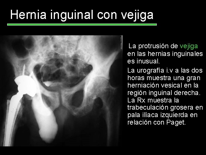 Hernia inguinal con vejiga La protrusión de vejiga en las hernias inguinales es inusual.