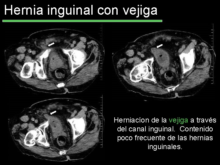 Hernia inguinal con vejiga Herniacíon de la vejiga a través del canal inguinal. Contenido