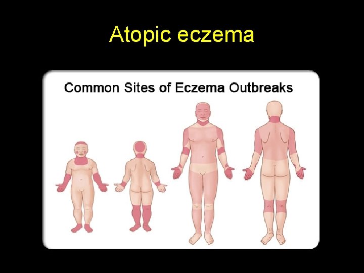 Atopic eczema 