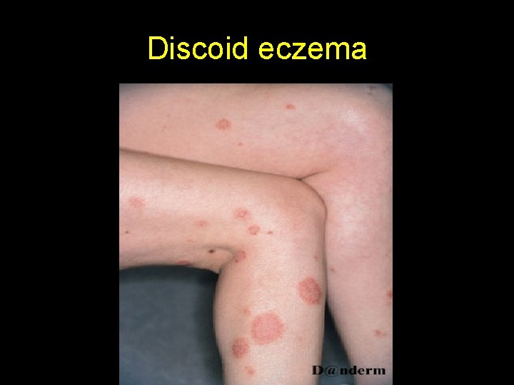 Discoid eczema 