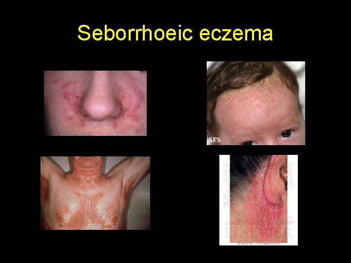 Seborrhoeic eczema 