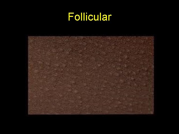 Follicular 