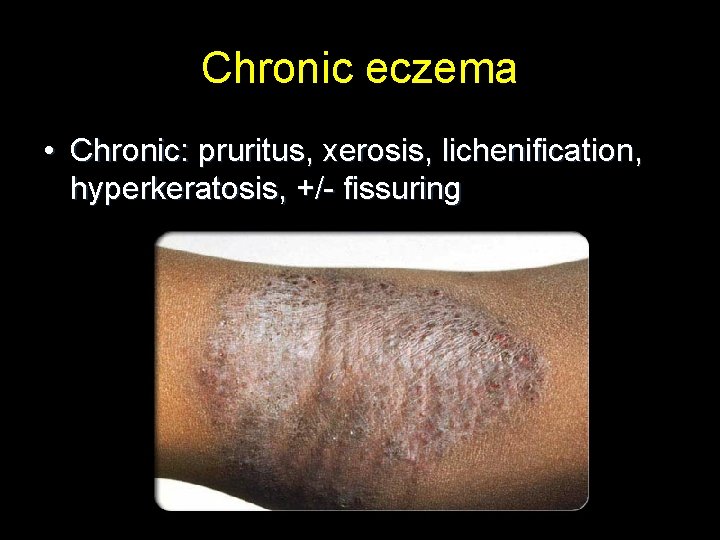 Chronic eczema • Chronic: pruritus, xerosis, lichenification, hyperkeratosis, +/- fissuring 