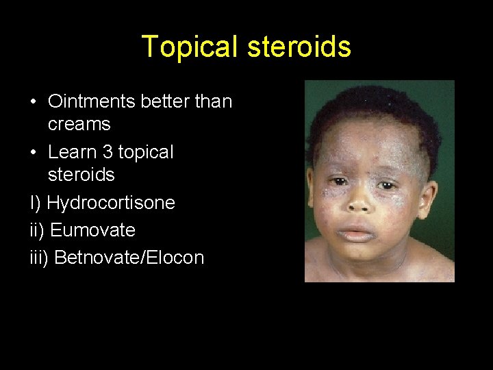Topical steroids • Ointments better than creams • Learn 3 topical steroids I) Hydrocortisone