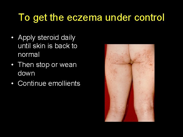 To get the eczema under control • Apply steroid daily until skin is back