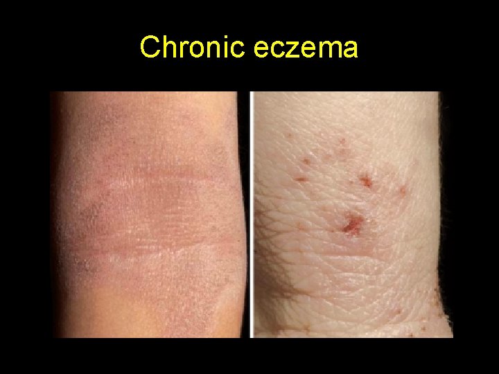 Chronic eczema 