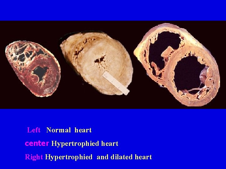 Left Normal heart center Hypertrophied heart Right Hypertrophied and dilated heart Left Normal heart center Hypertrophied heart Right Hypertrophied and dilated heart