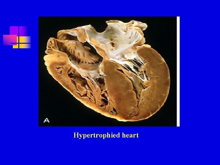 Hypertrophied heart Hypertrophied heart