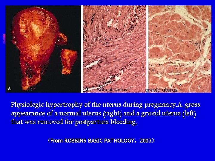 Normal uterus gravid uterus Physiologic hypertrophy of the uterus during pregnancy. A, gross appearance Normal uterus gravid uterus Physiologic hypertrophy of the uterus during pregnancy. A, gross appearance