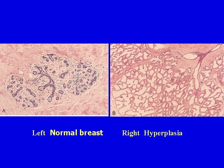 Left Normal breast Right Hyperplasia Left Normal breast Right Hyperplasia
