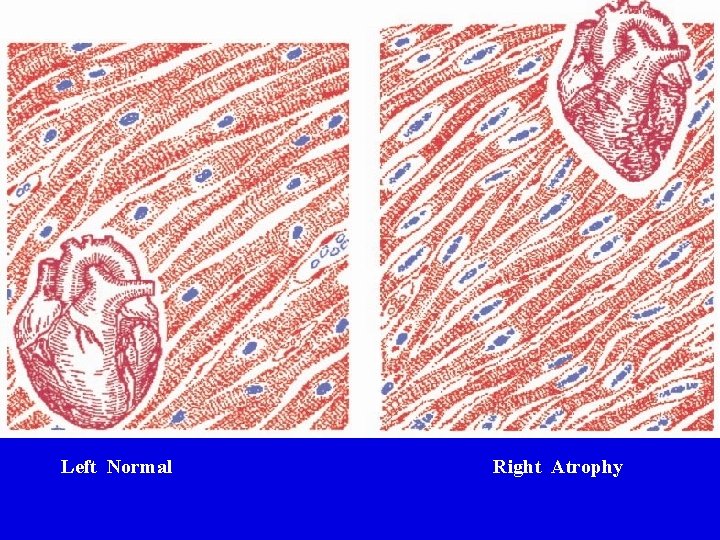 Left Normal Right Atrophy Left Normal Right Atrophy