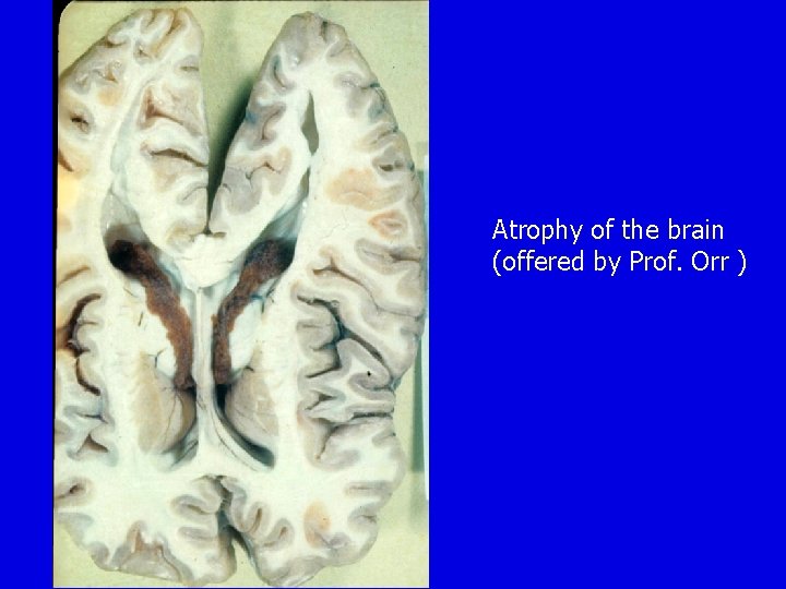 Atrophy of the brain (offered by Prof. Orr ) Atrophy of the brain (offered by Prof. Orr )