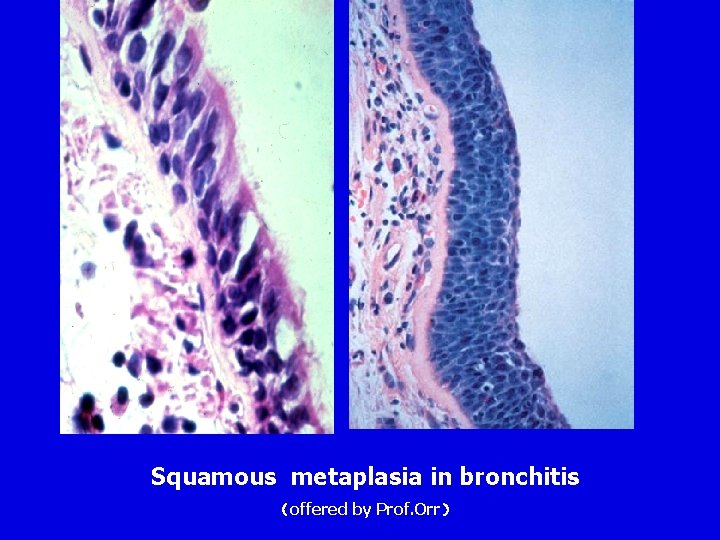 Squamous metaplasia in bronchitis (offered by Prof. Orr) Squamous metaplasia in bronchitis (offered by Prof. Orr)