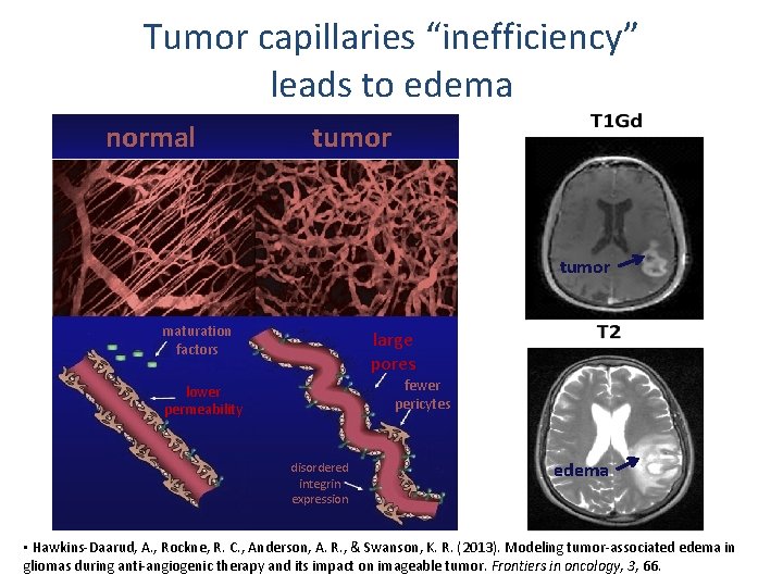 Tumor capillaries “inefficiency” leads to edema normal tumor maturation factors large pores fewer pericytes Tumor capillaries “inefficiency” leads to edema normal tumor maturation factors large pores fewer pericytes