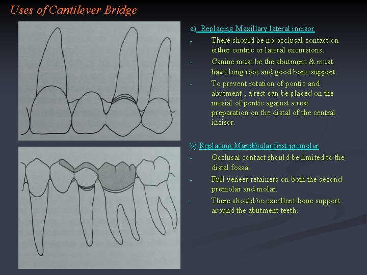 Uses of Cantilever Bridge a) Replacing Maxillary lateral incisor There should be no occlusal