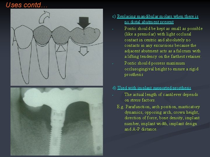 Uses contd… c) Replacing mandibular molars when there is no distal abutment present Pontic