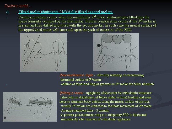 Factors contd… v) Tilted molar abutments / Mesially tilted second molars - Common problem