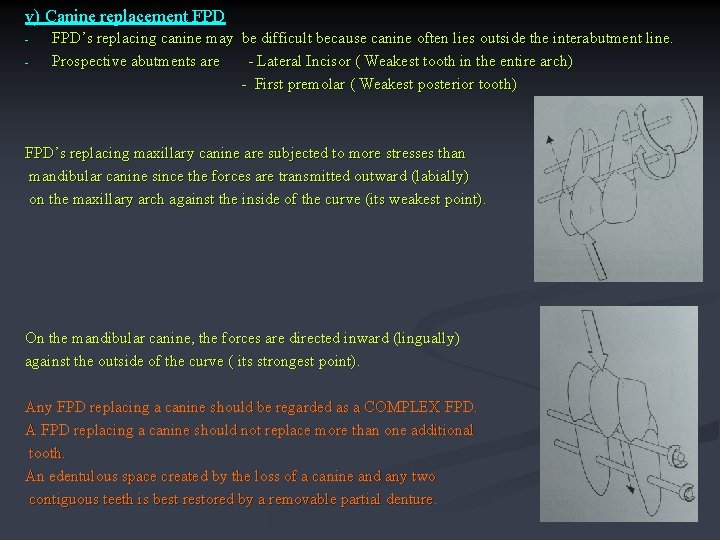 v) Canine replacement FPD - FPD’s replacing canine may be difficult because canine often