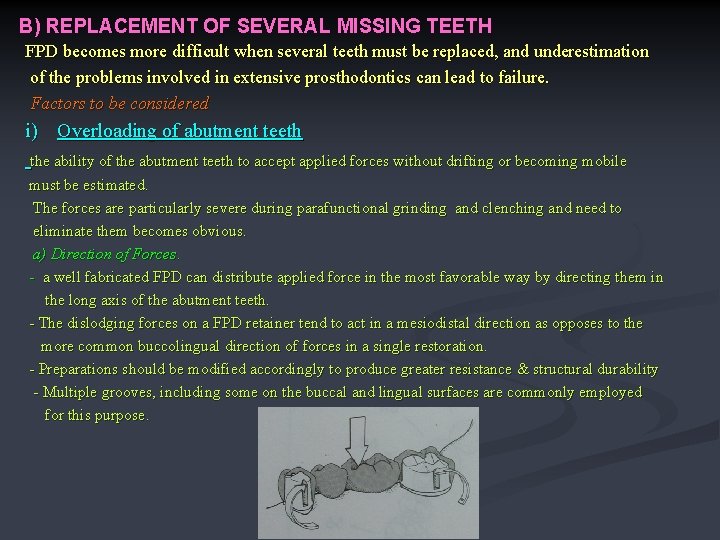 B) REPLACEMENT OF SEVERAL MISSING TEETH FPD becomes more difficult when several teeth must