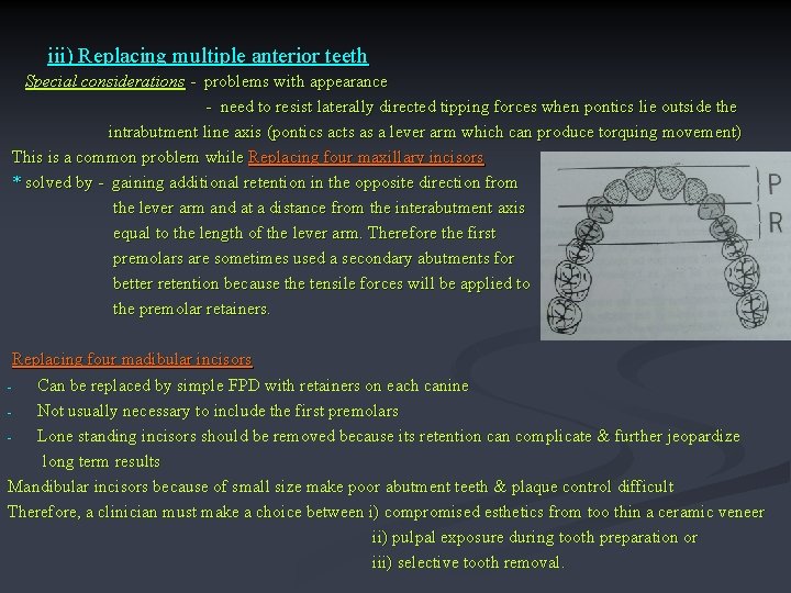 iii) Replacing multiple anterior teeth Special considerations - problems with appearance - need to