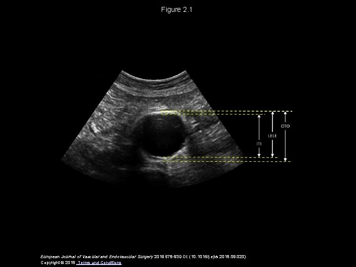 Figure 2. 1 European Journal of Vascular and Endovascular Surgery 2019 578 -93 DOI: