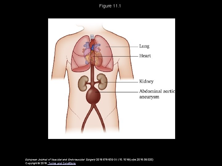 Figure 11. 1 European Journal of Vascular and Endovascular Surgery 2019 578 -93 DOI: