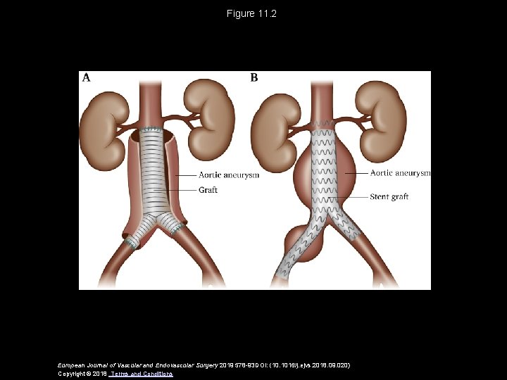 Figure 11. 2 European Journal of Vascular and Endovascular Surgery 2019 578 -93 DOI: