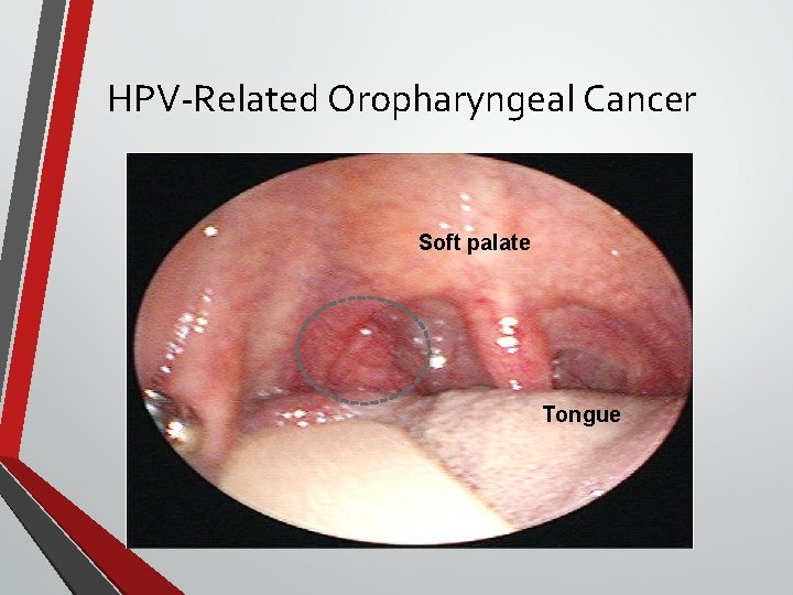 HPV-Related Oropharyngeal Cancer Soft palate Tongue 