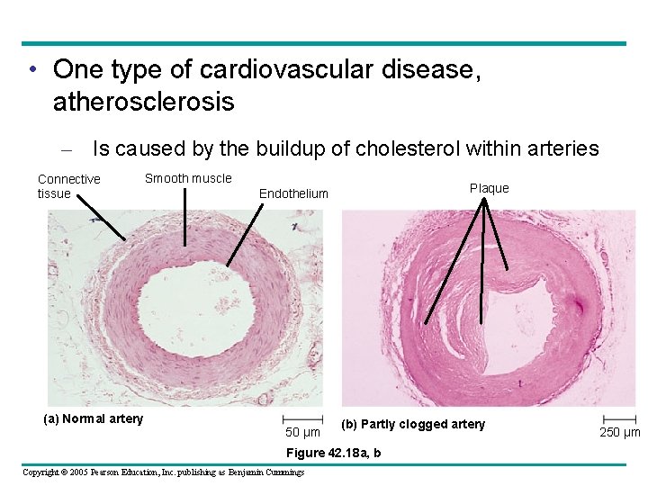  • One type of cardiovascular disease, atherosclerosis – Is caused by the buildup