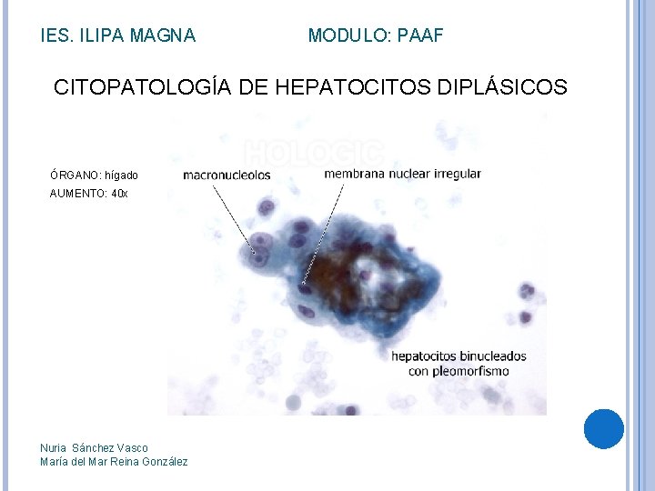 IES. ILIPA MAGNA MODULO: PAAF CITOPATOLOGÍA DE HEPATOCITOS DIPLÁSICOS ÓRGANO: hígado AUMENTO: 40 x