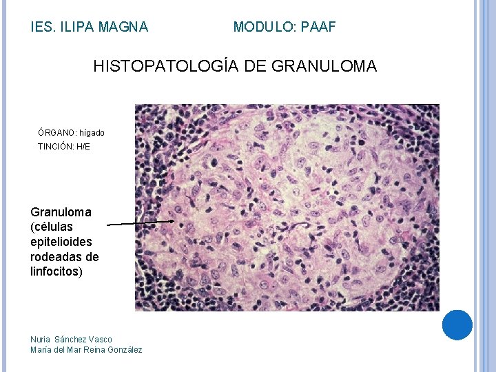 IES. ILIPA MAGNA MODULO: PAAF HISTOPATOLOGÍA DE GRANULOMA ÓRGANO: hígado TINCIÓN: H/E Granuloma (células