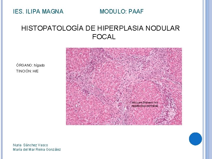 IES. ILIPA MAGNA MODULO: PAAF HISTOPATOLOGÍA DE HIPERPLASIA NODULAR FOCAL ÓRGANO: hígado TINCIÓN: H/E