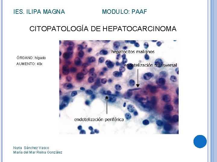 IES. ILIPA MAGNA MODULO: PAAF CITOPATOLOGÍA DE HEPATOCARCINOMA ÓRGANO: hígado AUMENTO: 40 x Nuria