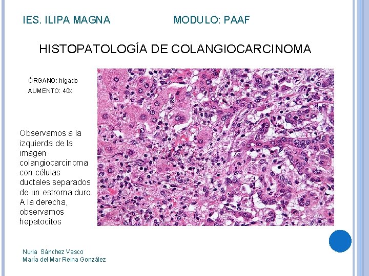 IES. ILIPA MAGNA MODULO: PAAF HISTOPATOLOGÍA DE COLANGIOCARCINOMA ÓRGANO: hígado AUMENTO: 40 x Observamos