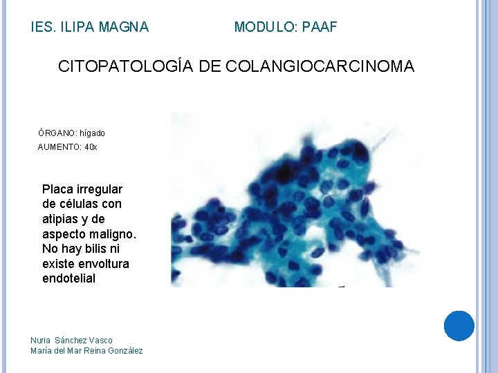 IES. ILIPA MAGNA MODULO: PAAF CITOPATOLOGÍA DE COLANGIOCARCINOMA ÓRGANO: hígado AUMENTO: 40 x Placa