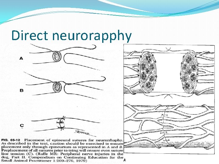 Direct neurorapphy Epineural sutures. No perineural sutures. 7 -0, 9 -0 nonabsorbable sutures. No