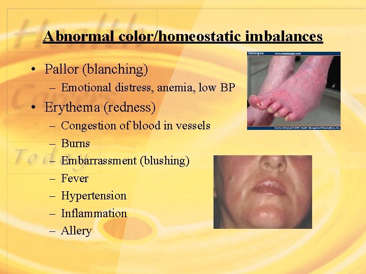Abnormal color/homeostatic imbalances • Pallor (blanching) – Emotional distress, anemia, low BP • Erythema
