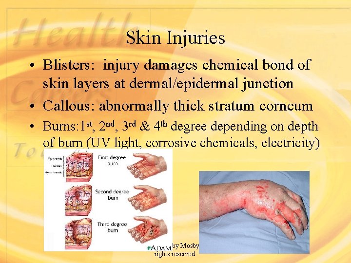 Skin Injuries • Blisters: injury damages chemical bond of skin layers at dermal/epidermal junction
