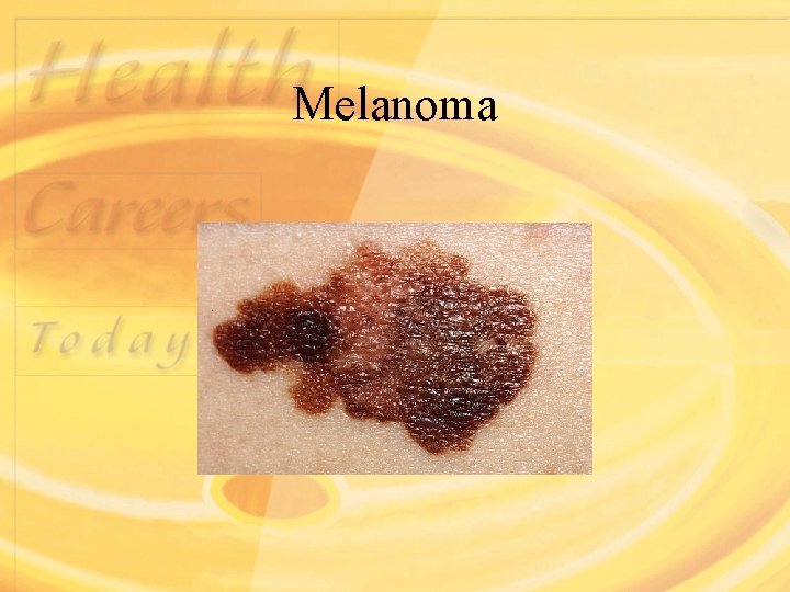 Melanoma 