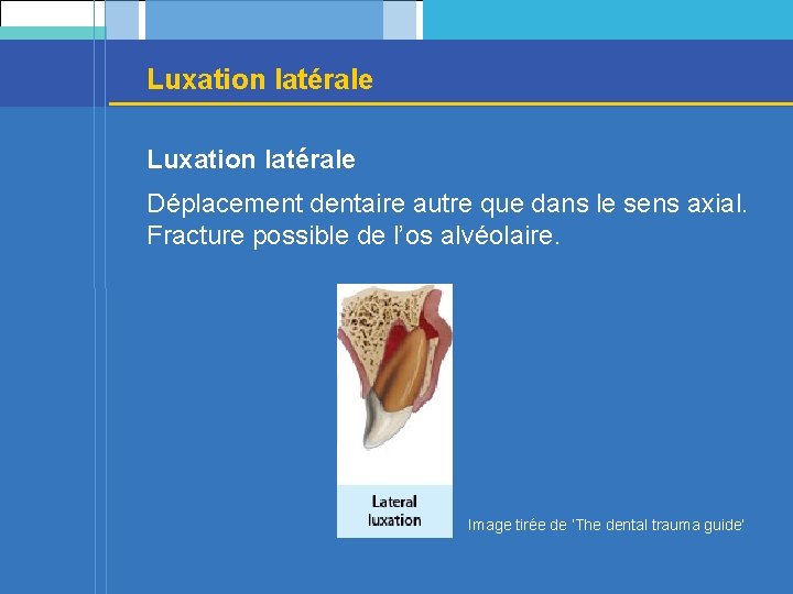 Luxation latérale Déplacement dentaire autre que dans le sens axial. Fracture possible de l’os