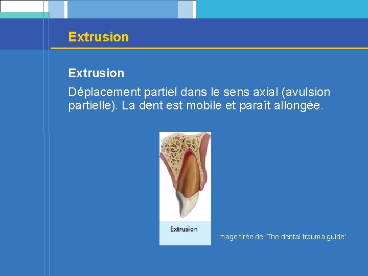 Extrusion Déplacement partiel dans le sens axial (avulsion partielle). La dent est mobile et