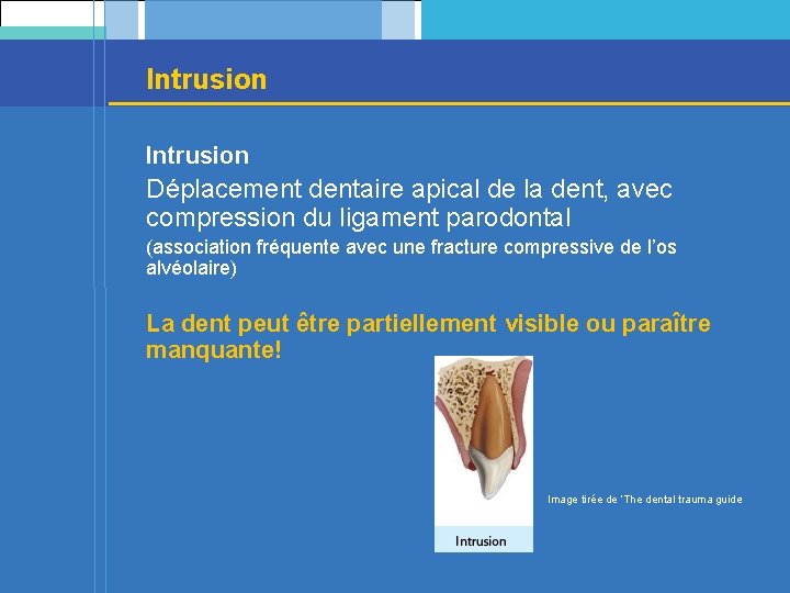 Intrusion Déplacement dentaire apical de la dent, avec compression du ligament parodontal (association fréquente